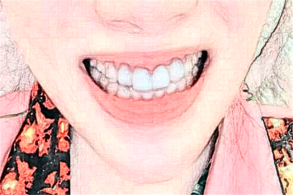 2024河北大學(xué)附屬醫(yī)院牙齒矯正多少錢(qián)_牙齒矯正醫(yī)生推薦