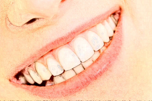 2024無錫市人民醫(yī)院牙齒矯正好嗎?附價(jià)格表+案例