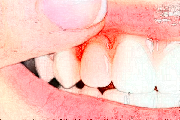 福州登特口腔醫(yī)院微創(chuàng)種植費(fèi)用多少_醫(yī)生名單