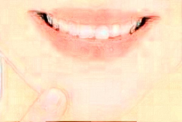 重慶世紀美奧口腔醫(yī)院怎么樣?牙齒矯正案例