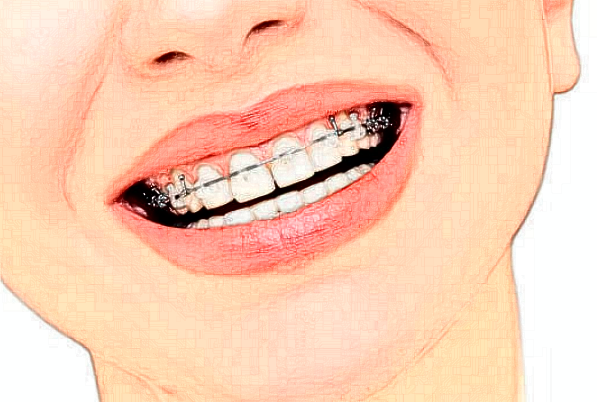 2024北京牙管家口腔診所自鎖托槽矯正怎么樣_專家信息_案例大全欣賞