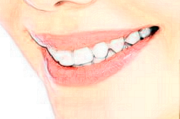 2024杭州雅萊口腔瓷貼面價(jià)格來咯!還有案例可以參考