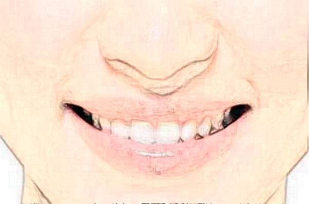 2024福州美橙口腔全瓷冠好不好?附術后案例參考!