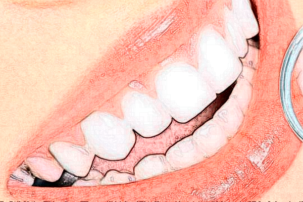 上海華美醫(yī)療美容醫(yī)院根管價(jià)目(價(jià)格)表_怎么樣