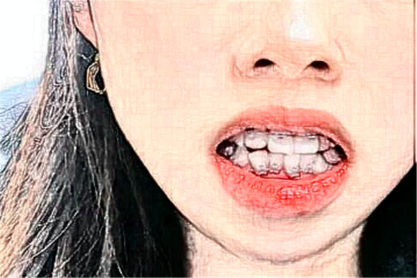 長(zhǎng)沙科爾雅口腔醫(yī)院半口種植案例_專家介紹