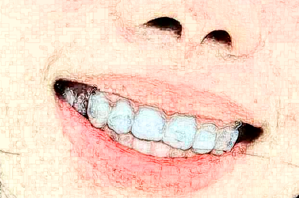 成都新橋口腔醫(yī)院補(bǔ)牙怎么樣費(fèi)用高嗎?補(bǔ)牙疼嗎