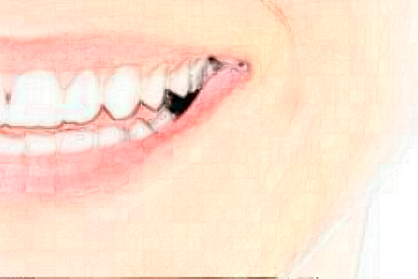 淮安諾貝爾口腔醫(yī)院虎牙矯正怎么樣?貴,但是值得!