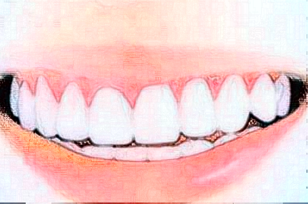 2024福州美橙口腔牙齒貼面好不好?附術(shù)后案例參考!