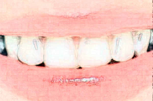 延安牙衛(wèi)士口腔樹脂補(bǔ)牙價(jià)格(價(jià)目)_案例_