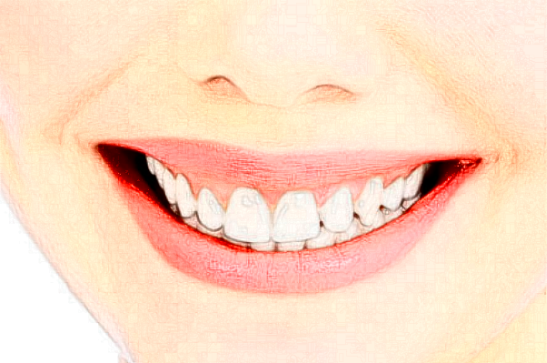 延安牙衛(wèi)士口腔樹脂補(bǔ)牙價(jià)格(價(jià)目)_案例_