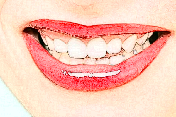 2024重慶團(tuán)圓口腔醫(yī)院齙牙矯正價(jià)格多少?齙牙矯正好嗎