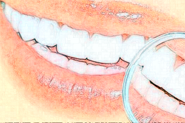 2024深圳樂莎莎口腔醫(yī)院隱形矯正價格?隱形矯正的優(yōu)點