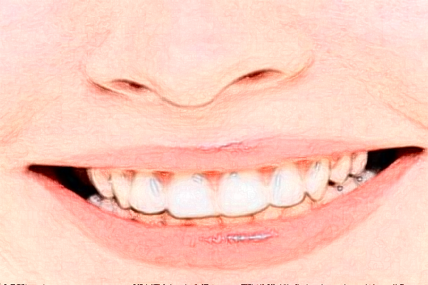 成都圣貝牙科醫(yī)院全口種植價(jià)格多少?整形日記全過(guò)程分享