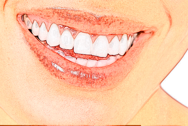 深圳樂莎莎口腔醫(yī)院種植牙好嗎?種植牙有后遺癥嗎