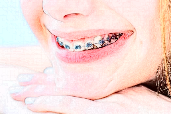 2024宣城大醫(yī)醫(yī)院金屬托槽矯正價格?金屬托槽矯正好嗎