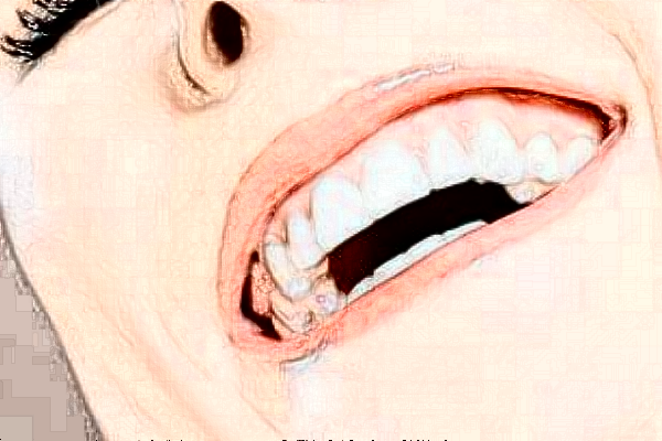 無(wú)錫市人民醫(yī)院種植牙怎么樣_案例分享