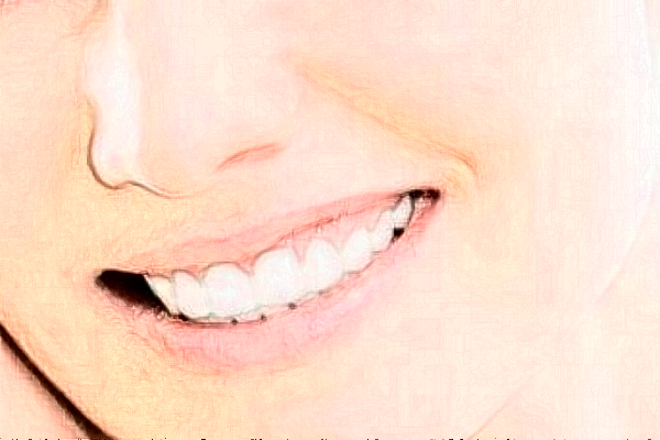 2024深圳樂莎莎口腔醫(yī)院拔牙費(fèi)用?拔牙后注意事項