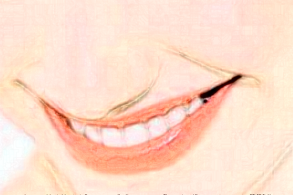 2024深圳樂莎莎口腔醫(yī)院拔牙費(fèi)用?拔牙后注意事項