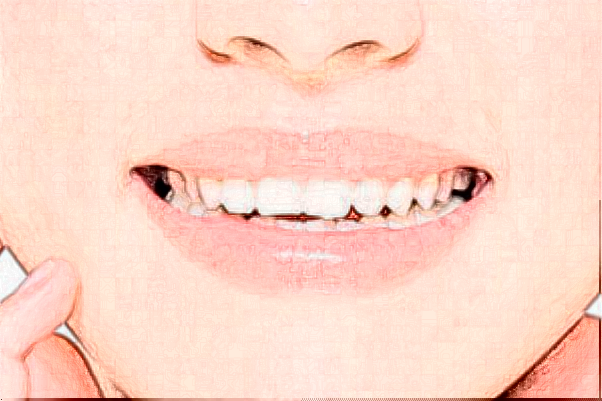 杭州植得口腔門(mén)診部前牙種植怎么樣?醫(yī)生介紹_案例分享