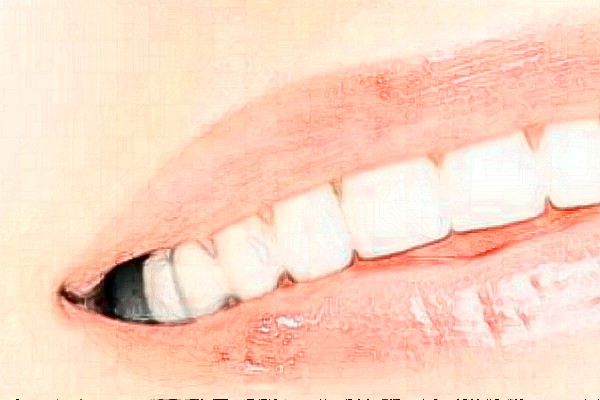 成都圣貝牙科醫(yī)院牙列擁擠矯正怎么樣|醫(yī)生介紹|價(jià)格收費(fèi)