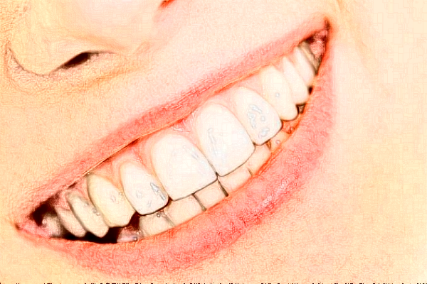 延安牙衛(wèi)士口腔瓷貼面價目表(價格表)_口碑怎么樣