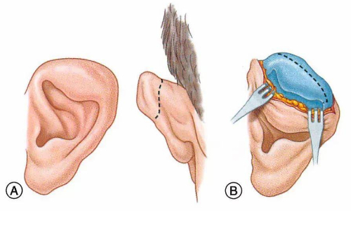 上海薇琳醫(yī)療美容醫(yī)院耳朵整形技術(shù)評(píng)測(cè)怎么樣?術(shù)后三個(gè)月求美案例