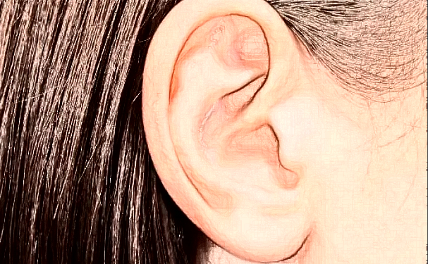 西寧華美整形醫(yī)院招風(fēng)耳矯正技術(shù)怎么樣?收費(fèi)標(biāo)準(zhǔn)?120天案例欣賞