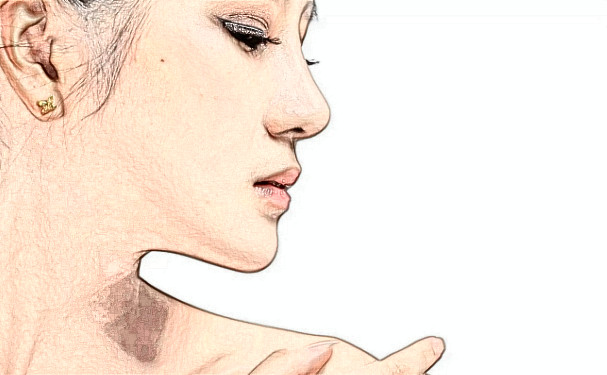 寧波童顏整形招風(fēng)耳矯正技術(shù)怎么樣?90天恢復(fù)案例