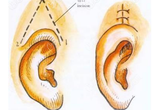 威海孫漫醫(yī)療美容診所杯狀耳矯正技術(shù)怎么樣?費用標準?術(shù)后半年案例