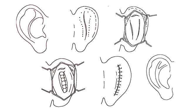 江蘇施爾美整形美容醫(yī)院杯狀耳整形技術(shù)怎么樣?90天案例揭秘|需要多少錢