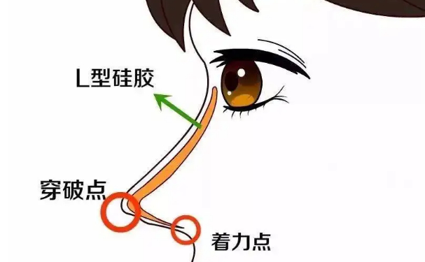 昭通民眾醫(yī)院隆鼻手術(shù)術(shù)后半年案例欣賞|技術(shù)評(píng)價(jià)怎么樣?價(jià)格查詢