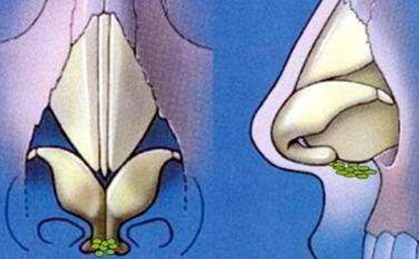 鄭州市蘊美醫(yī)療美容耳軟骨隆鼻術(shù)后三個月案例欣賞&技術(shù)怎么樣?