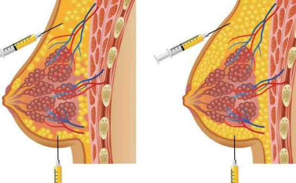 濟(jì)寧任城壹美天成醫(yī)療美容醫(yī)院自體脂肪隆胸術(shù)后半年求美案例(效果怎么樣?技術(shù)等級)