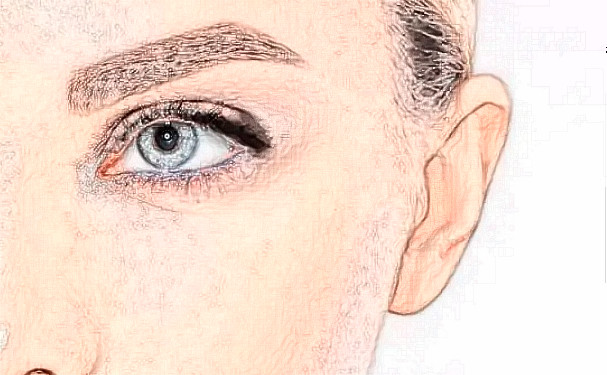 沈陽(yáng)碧航醫(yī)療診所定點(diǎn)雙眼皮半年術(shù)后案例反饋&技術(shù)怎么樣?