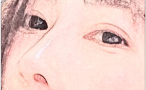 泰安雅汀醫(yī)學(xué)美容診所腫泡眼雙眼皮價格查詢?技術(shù)優(yōu)點(diǎn)怎么樣?