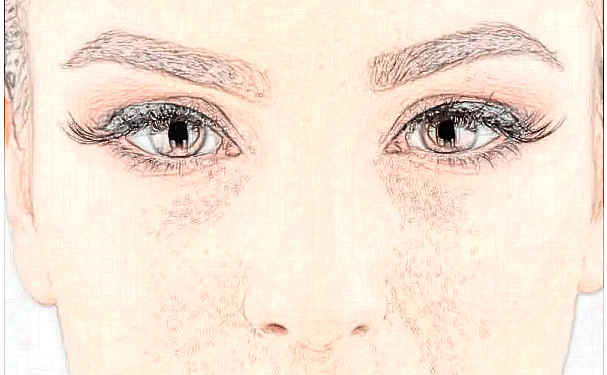 蘇州美萊美容醫(yī)院全切雙眼皮一年術(shù)后恢復(fù)案例&價格一覽表?