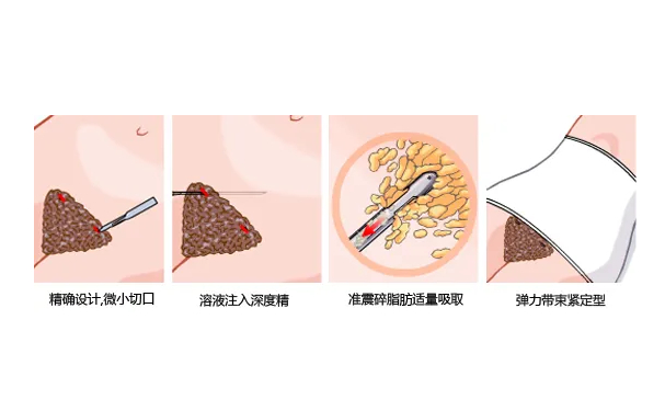 佛山順德壹加壹美容醫(yī)院共振吸脂技術(shù)級(jí)別怎么樣?案例點(diǎn)評(píng)&費(fèi)用明細(xì)