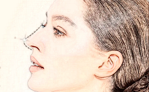 湖南禾信植發(fā)頭發(fā)種植一年案例反饋(效果怎么樣?技術亮點)