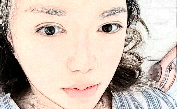 沈陽友誼美容醫(yī)院脂肪填充90天案例曝光&技術(shù)怎么樣?