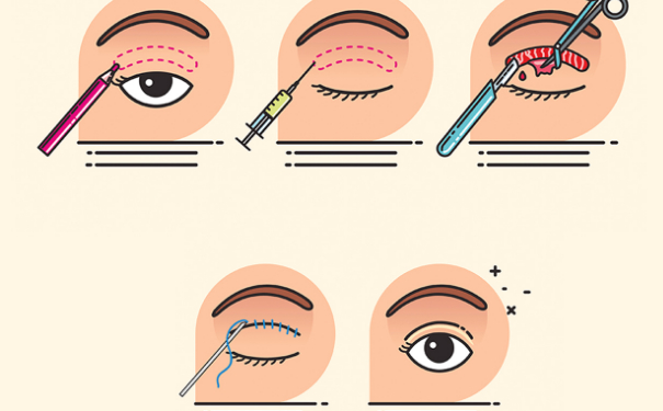 浙江省人民醫(yī)院冀宇腫泡眼雙眼皮價(jià)格多少?案例評(píng)價(jià),醫(yī)生信息