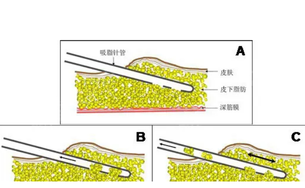 上海九院張國佑腰部抽脂90天案例&技術怎么樣?
