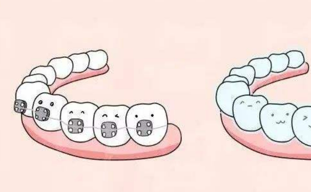 鄭州市第一人民醫(yī)院地包天矯正技術(shù)風(fēng)格怎么樣?術(shù)后6個(gè)月案例&效果測(cè)評(píng)