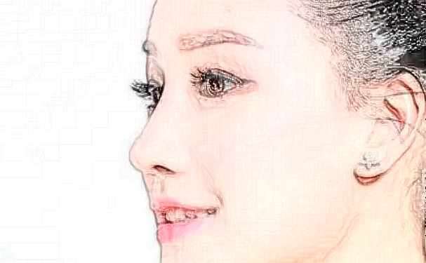 成都藝星謝雯面部提升求美案例&技術(shù)點(diǎn)評(píng)