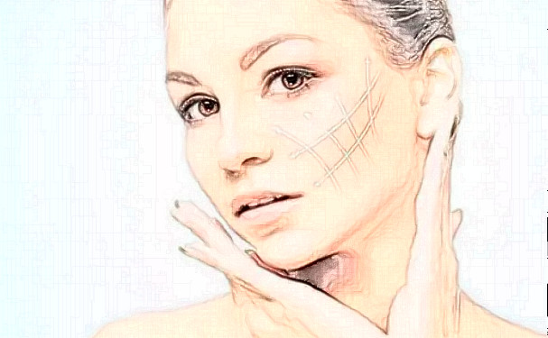 成都藝星謝雯面部提升求美案例&技術(shù)點(diǎn)評(píng)