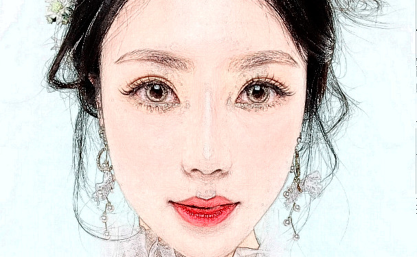 北京友誼醫(yī)院羅麗華去眼袋技術(shù)怎么樣?費用明細(xì)?案例反饋